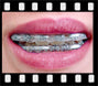 Faxx by Morgan Bumper Lip Protector for Braces, Clear